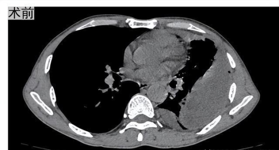 脓胸：发热背后的隐秘危机，早期手术可挽救生命