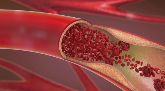 血脂不超标就不用太紧张，正常吃喝即可