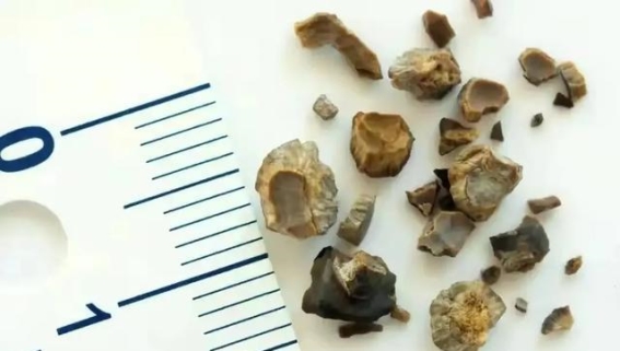 秋季柿子山楂应适量，胃石隐患不容忽视