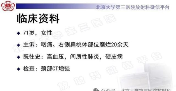 腭扁桃体淋巴瘤的临床挑战与发展前景