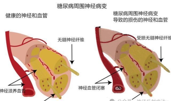 糖尿病周围神经病变的危害与防治