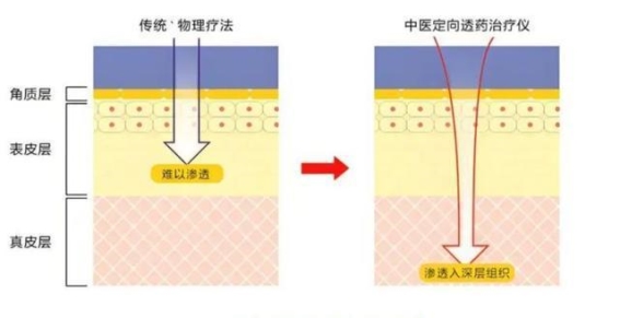 癌症治疗新曙光：中药微化渗透疗法为肿瘤复发控制提供新选择