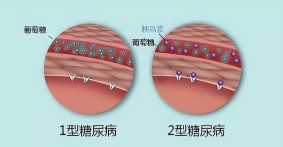 探索糖尿病无药物治疗的四种情境