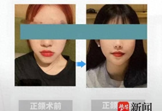 嘴凸、地包天、龅牙和大小脸，正颌与正畸联合治疗如何选择？