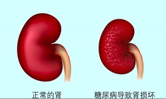 糖尿病肾病的早期信号及有效护肾方法