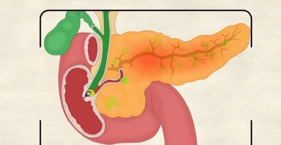 从眼睛看胰腺健康：你可能忽视的健康信号