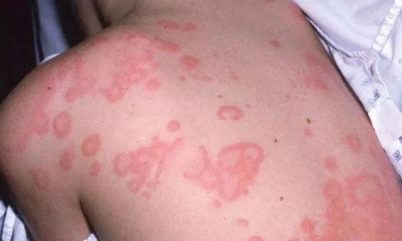 气血双补方，给皮肤筑起防护屏障，荨麻疹不再复发