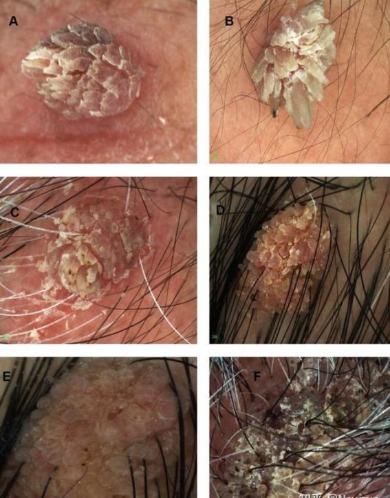 眼皮丝状疣的治疗与护理建议