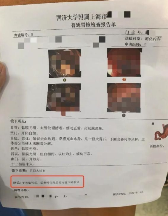 秋季山楂零食食用过量引发胃结石，医生提醒适量为宜