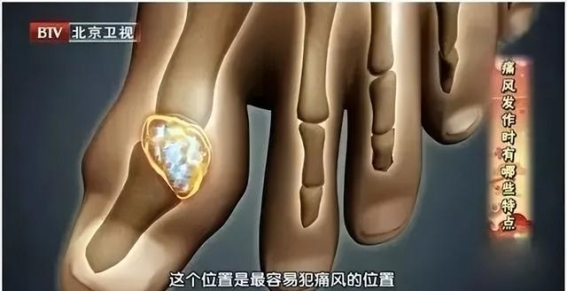 高尿酸的真正“元凶”：比饮食更值得警惕的健康隐患