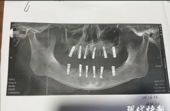 一次性拔牙23颗种植12颗，13天后心脏骤停——医疗安全的警钟