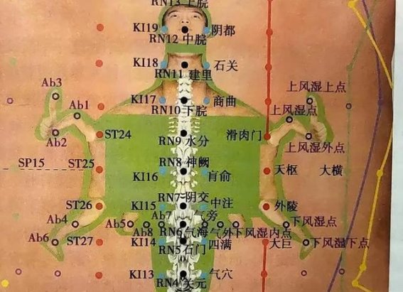 腹针疗法：急性腰痛的有效治疗新选择