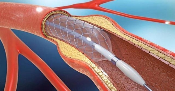 心脏支架手术后能活多久？医生实话实说：这3个因素最关键