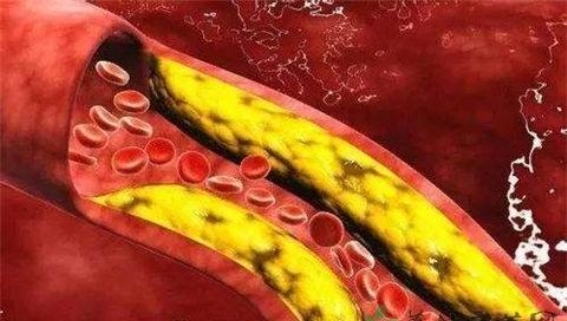 血管狭窄怎么办？这些方法帮你应对
