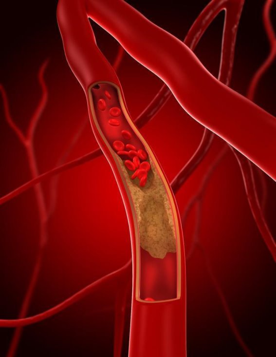 血管悄悄长斑变硬？医生提醒做好这4件事，血管更健康