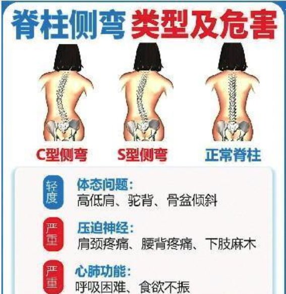 脊柱大梁的守护：青少年特发性脊柱侧弯防治的紧迫性