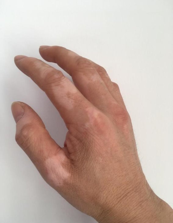 发现白斑别等！早发现早治疗，掌握这三大关键