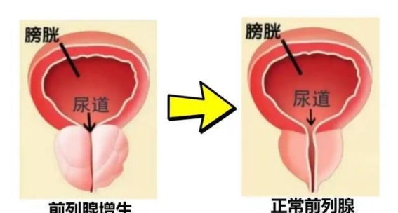 前列腺增生的困扰，泽泻药方带来新希望