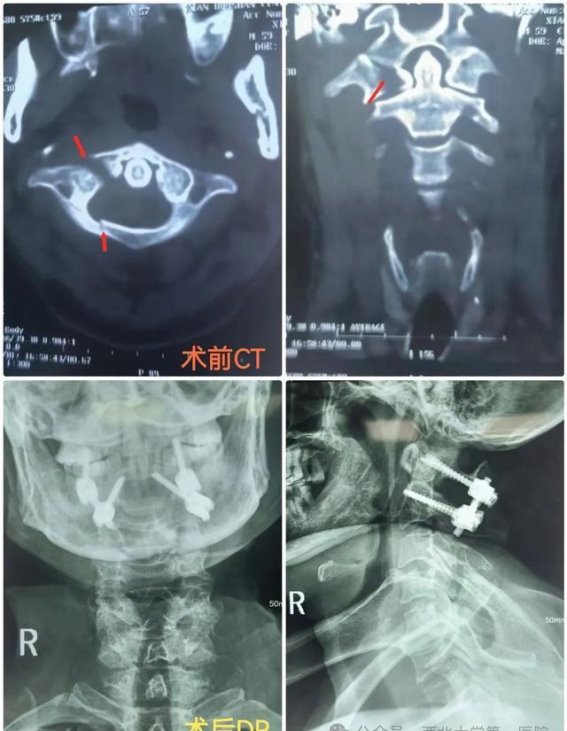 西北大学第一医院脊柱外科成功实施首例寰椎骨折手术：跨越技术难关，护航生命安全