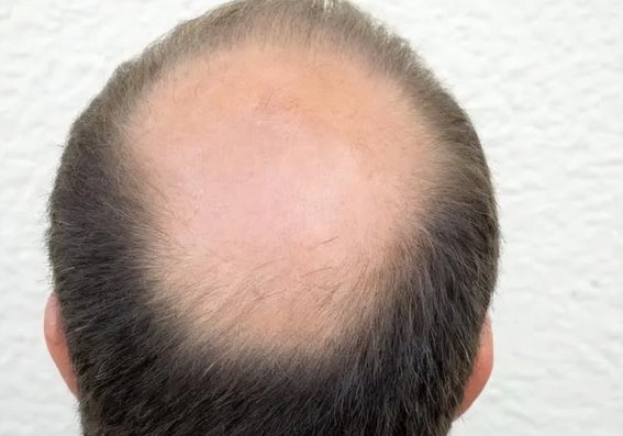 湿气重易脱发？中药调理让你头发越来越旺盛