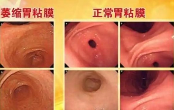 如何有效治疗萎缩性胃炎，重拾健康胃肠