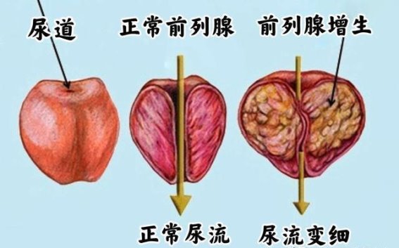 治前列腺增生，精准施药，气血调和，排淤通利