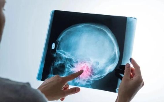 脑梗高发季节的警示：这些症状别忽视，早预防是关键