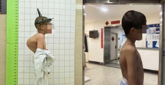 13岁脊柱侧弯患者成功治疗，父母喜悦难掩：孩子长高了十几公分！