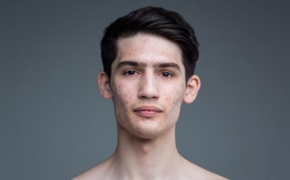 正确认识异维A酸软胶囊副作用，科学应对，避免过度恐慌